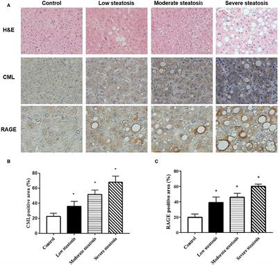 CML/RAGE Signal Bridges a Common Pathogenesis Between Atherosclerosis and Non-alcoholic Fatty Liver